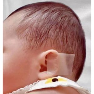 چسب اصلاح فرم گوش نوزاد
